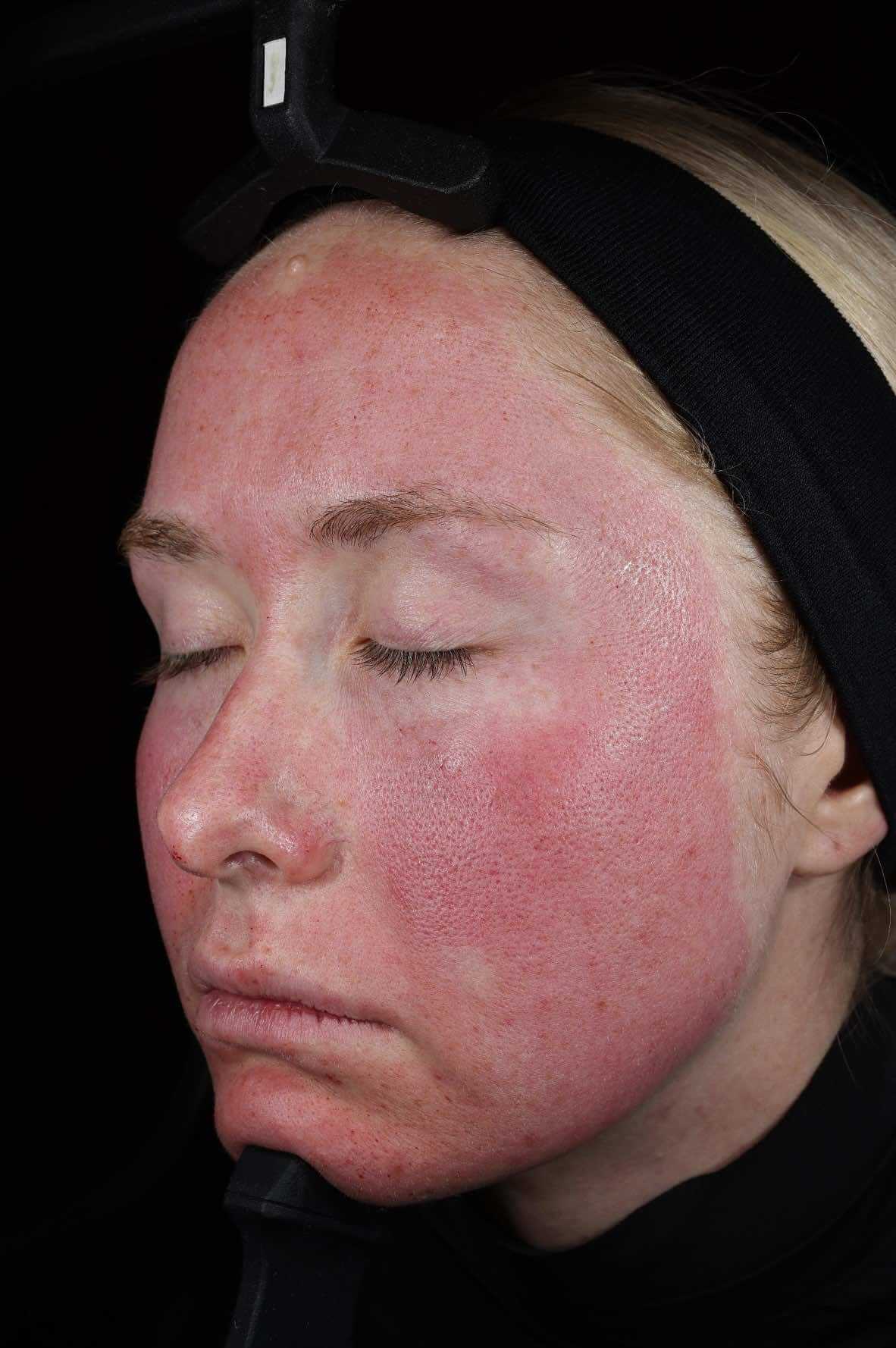 SkinPen treatment progress 4 Hours