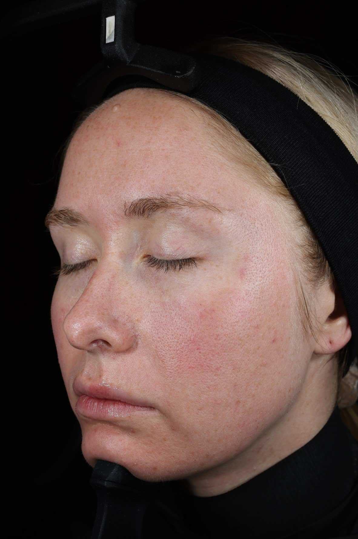 SkinPen treatment progress 24 Hours