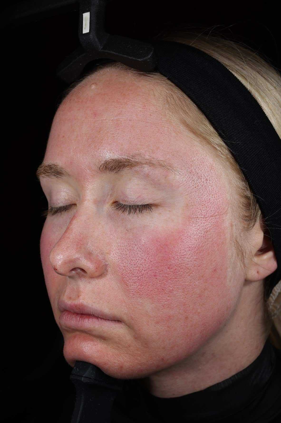 SkinPen treatment progress 1 Hour